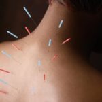 Acupuncture: The Solution You Didn’t Know You Needed